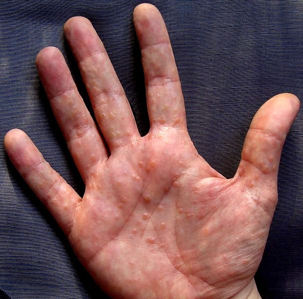 What causes itching hands?